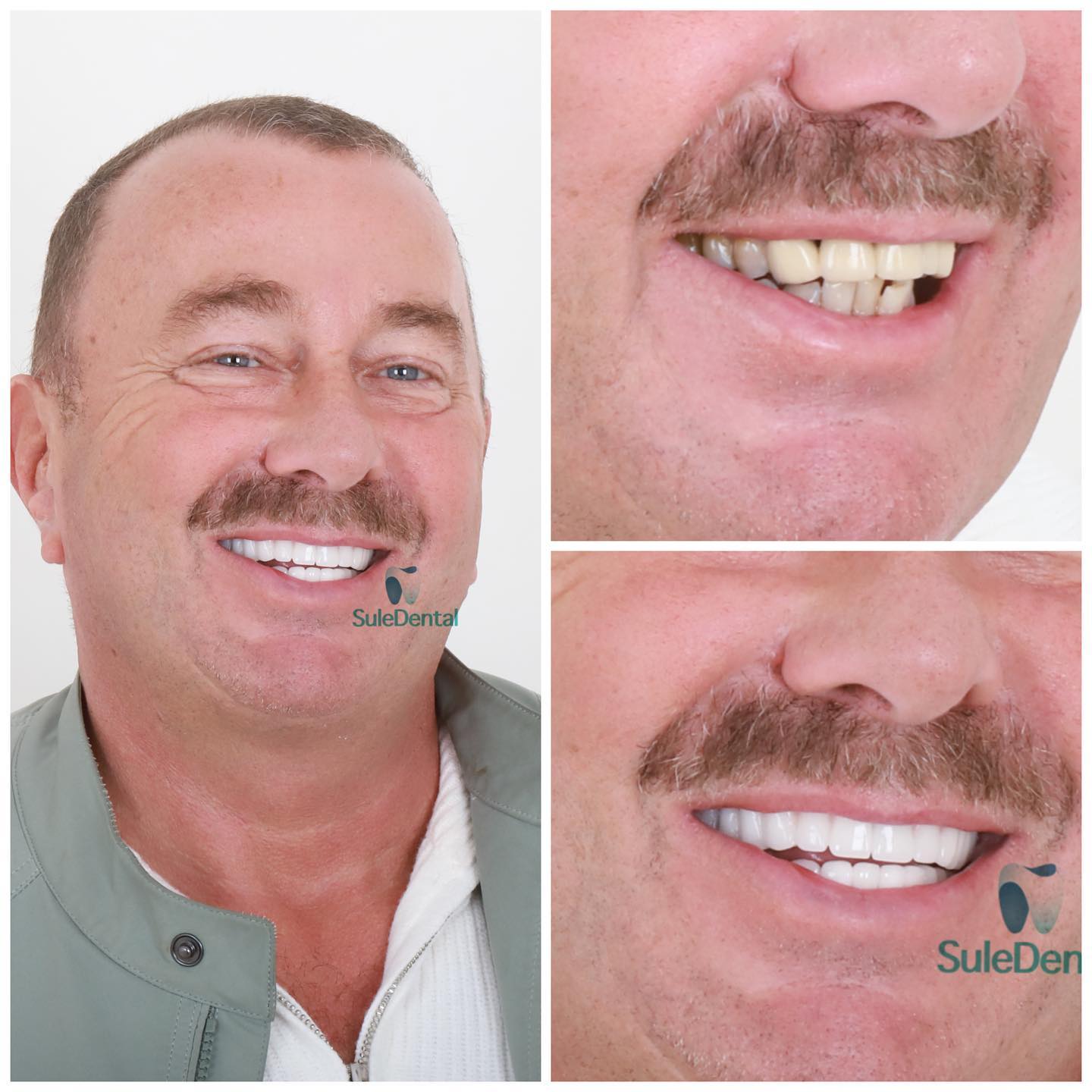 The Hollywood Smile How Sule Clinic Can Help You Get RedCarpet Ready